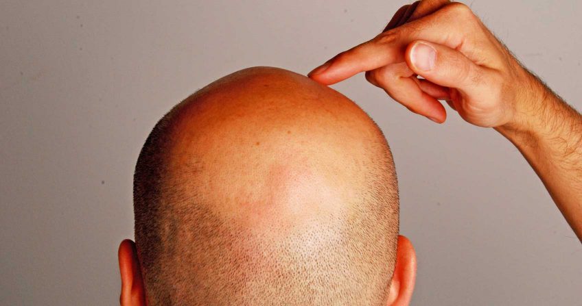 Traitement calvitie par greffe de cheveux FUE