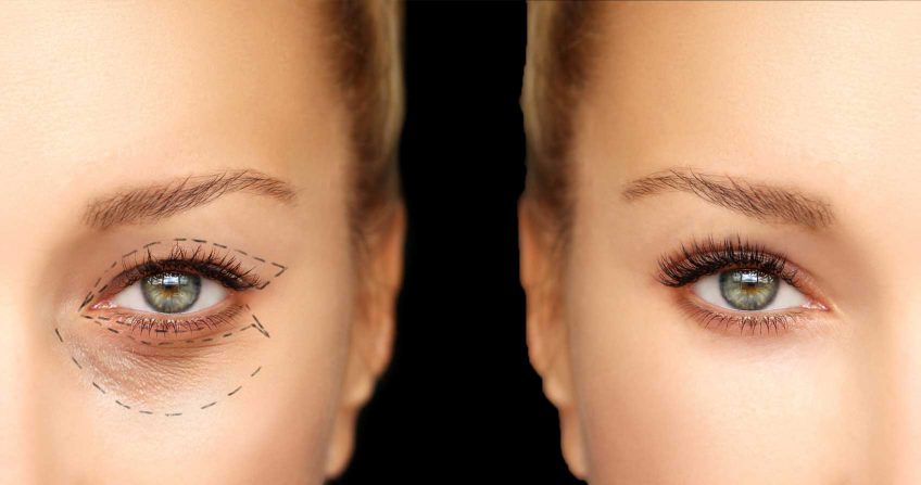 Blpharoplastie : Chirurgie esthtique des paupires | Dr Kevin Haddad
