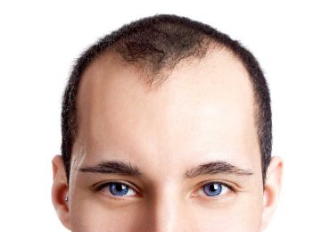 Greffe de cheveux - FUE