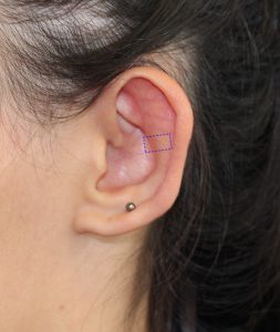 Chirurgie oreilles décollées implant Earfold