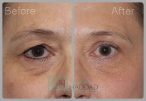 Résultat chirurgie paupières supérieures blépharoplastie