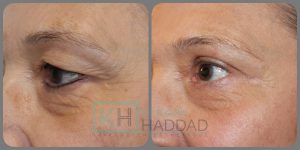 Chirurgie paupières tombantes