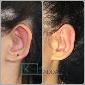 Chirurgie oreilles décollées Earfold