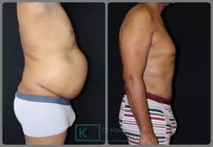 plastie abdominale résultat