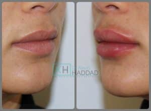 acide hyaluronique lèvres