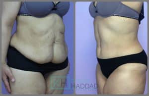 plastie abdominale resultat