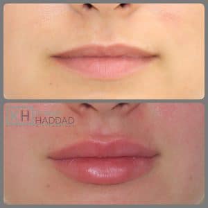 résultat acide hyaluronique lèvres