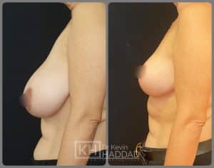 reduction mammaire resultat